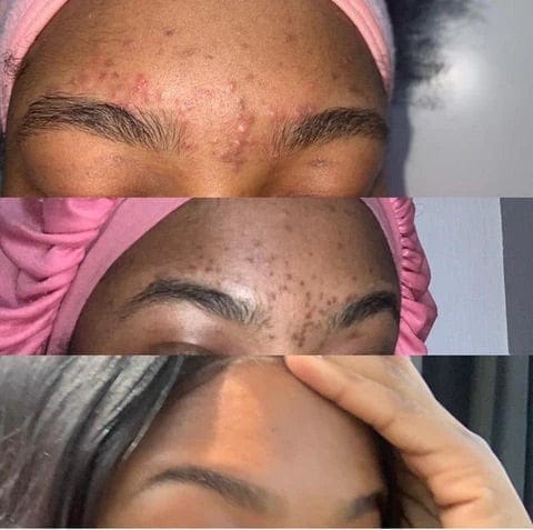 eczema and psoriasis before and after