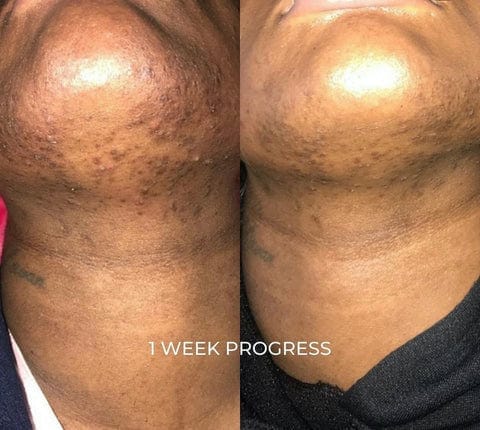 eczema and psoriasis before and after 1 week