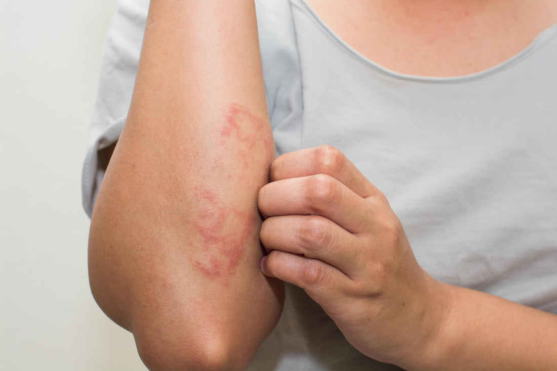 What is Eczema?