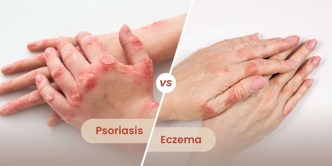 Eczema, Atopic Dermatitis, and Psoriasis: Understanding Skin Disorders and Natural Ways to Cope with them.